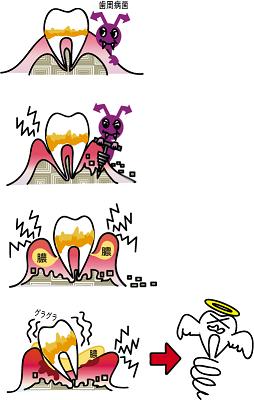 歯周病の仕組み